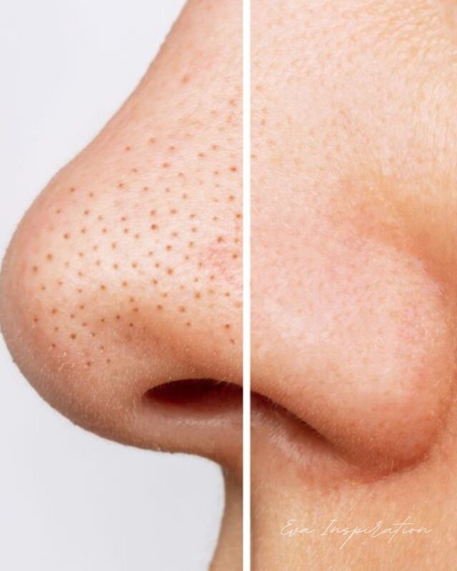 point noir nez avant apres